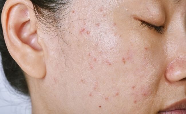 Gợi ý các thành phần nên có trong sữa rửa mặt cho da dầu mụn