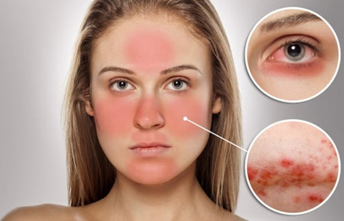 Da bị kích ứng là gì và dấu hiệu nhận biết